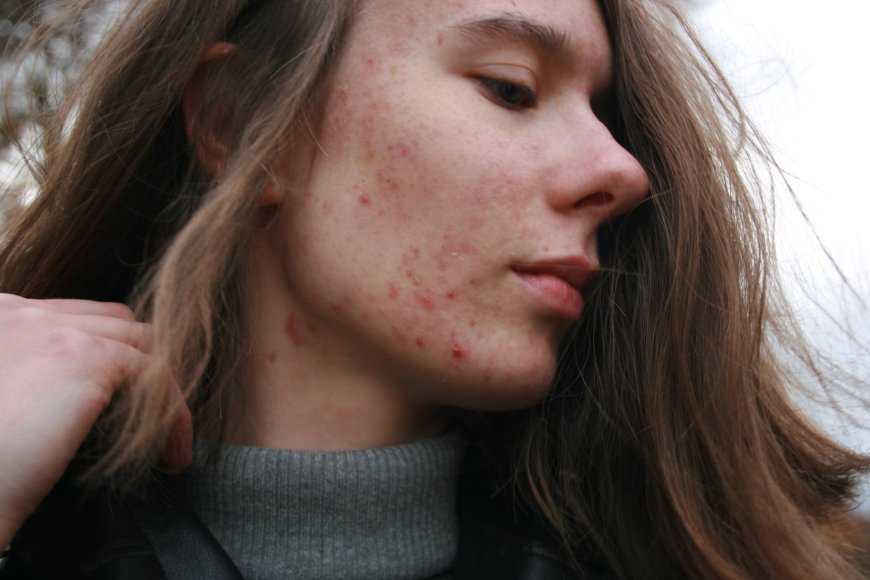 Acné: Oorzaken, Behandelingen en Tips voor een Stralende Huid