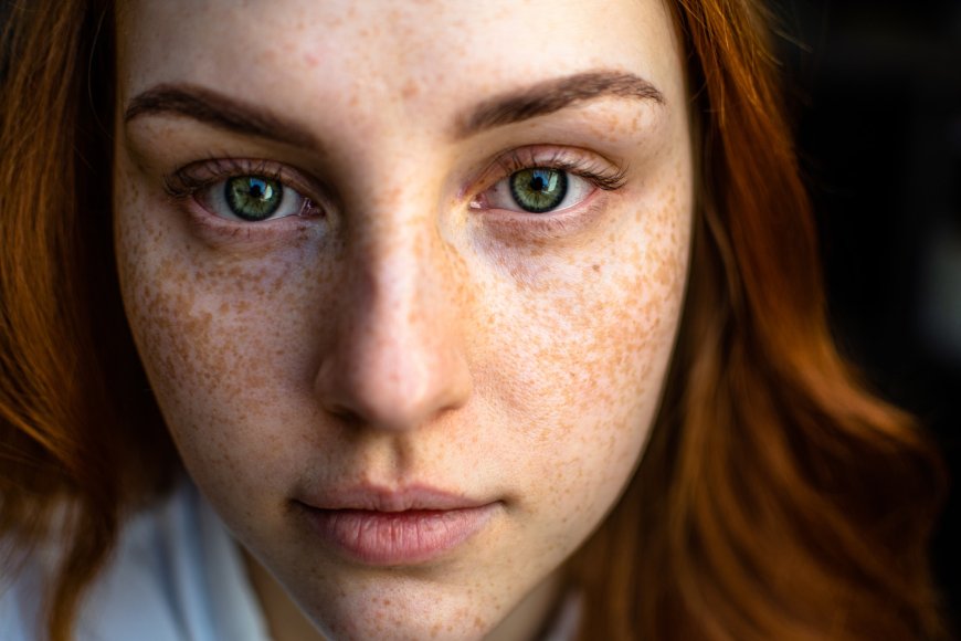 Psoriasis: Symptomen, Oorzaken en Effectieve Behandelopties